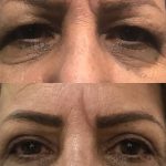 eye surgery in iran belpharoplasty